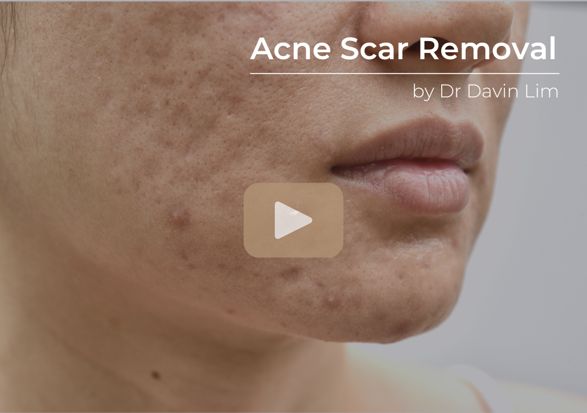 CO2 laser resurfacing acne scars