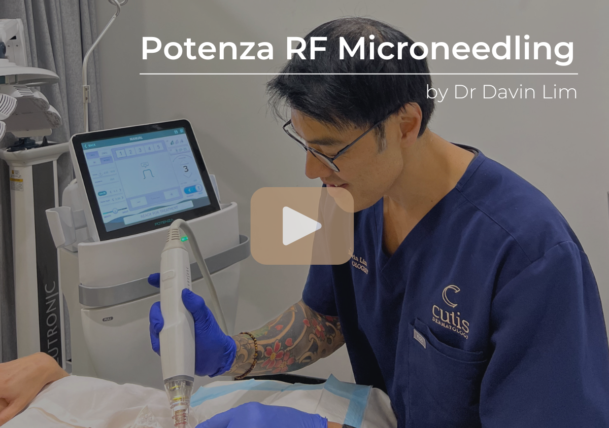 Potenza RF Microneedling Explained