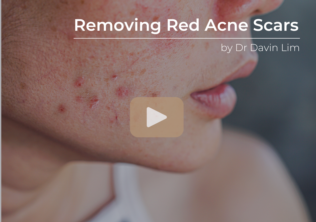 Red acne scars Removal; post inflammatory erythema, PIE