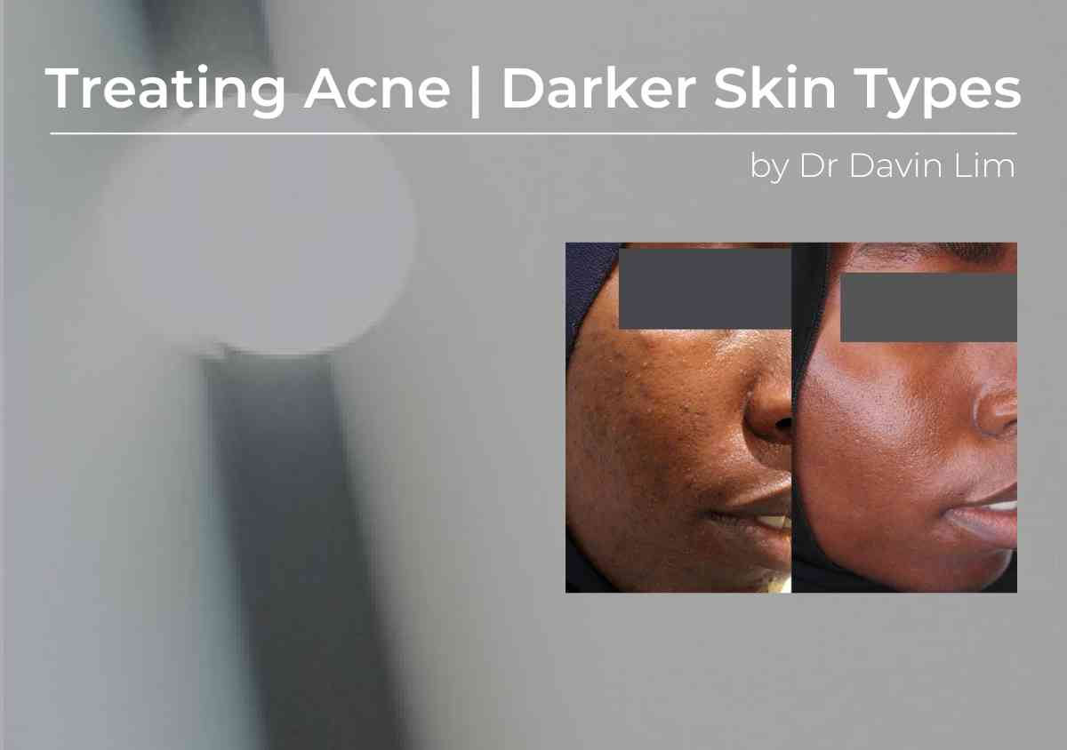 Treating acne in darker skin types