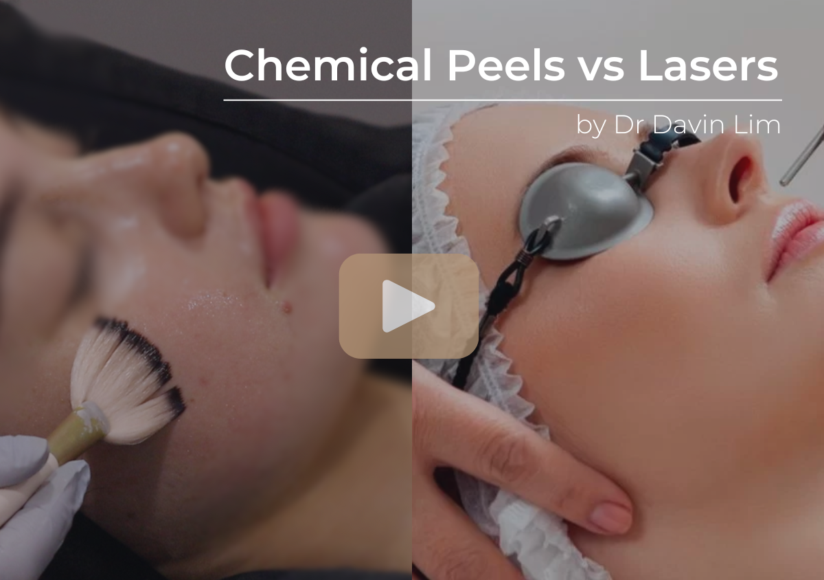 Chemical Peels vs Lasers for Melasma