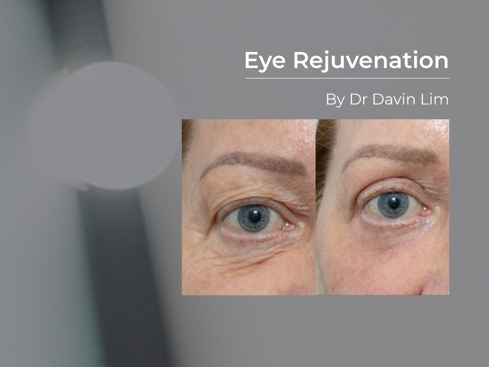 Eye rejuvenation surgery blepharoplasty