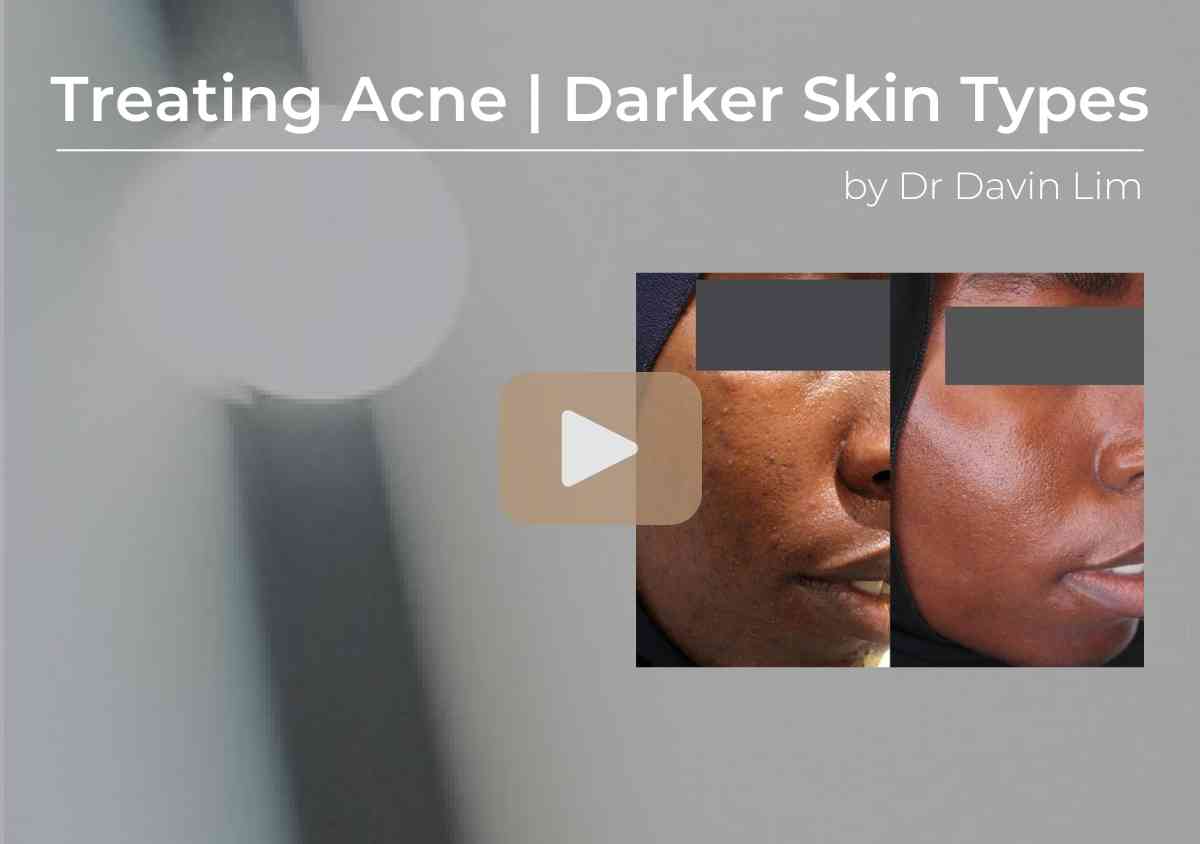 Treating acne in darker skin types