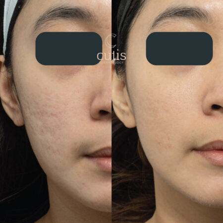 asian acne scar revision