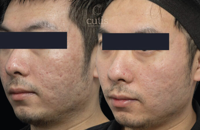 co2 acne scars
