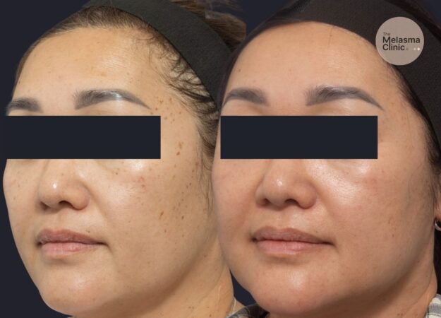 freckle pigment removal brisbane