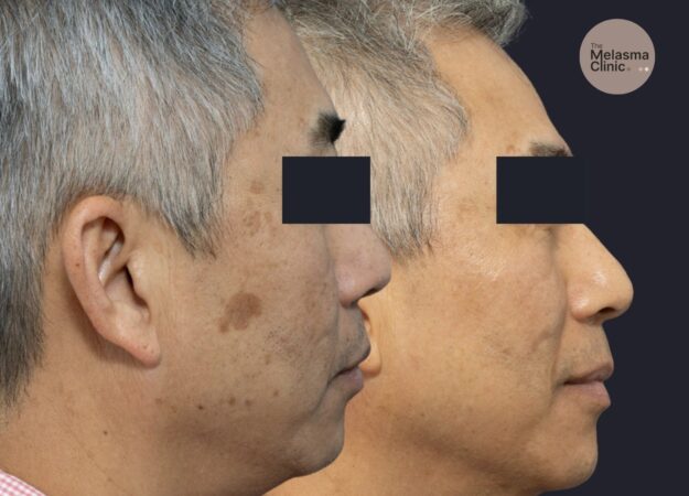 male pigment removal