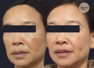 melasma pigment removal brisbane 937