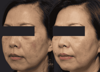 melasma removal 45