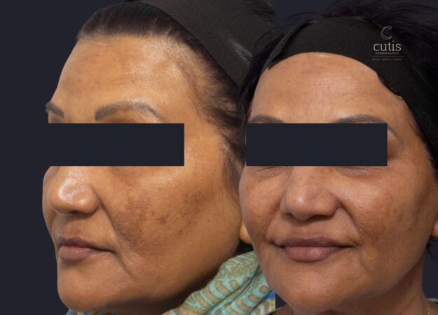 melasma treatment brisban 23