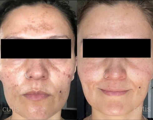 melasmapicosureproBA-img