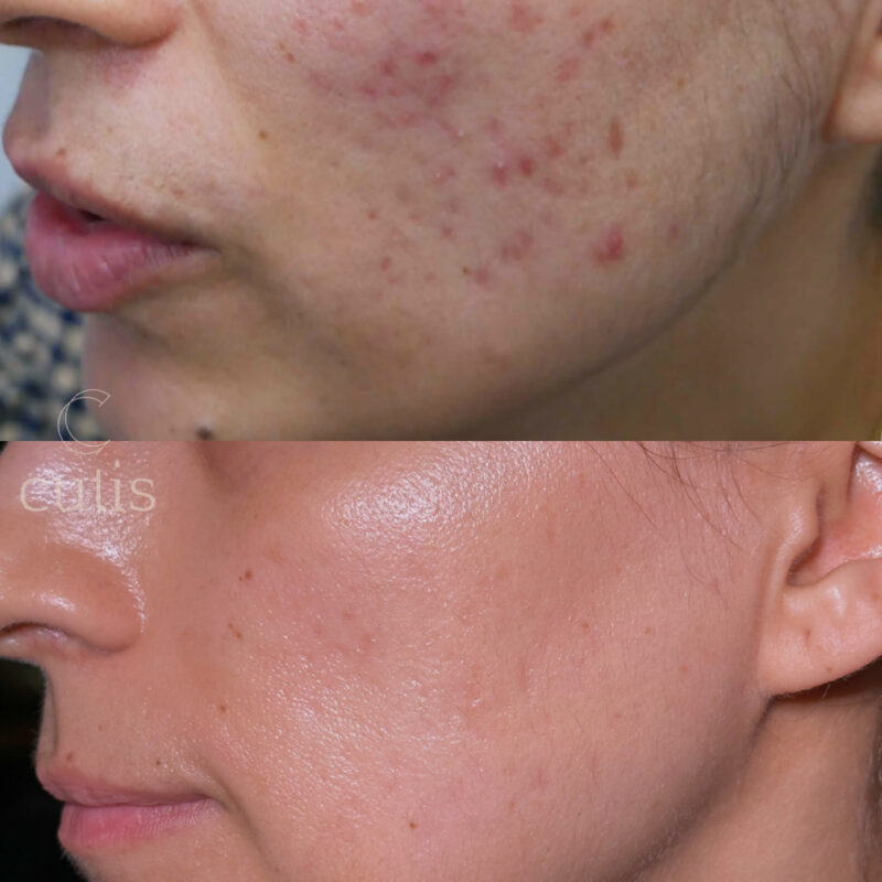 rejuran for acne scars