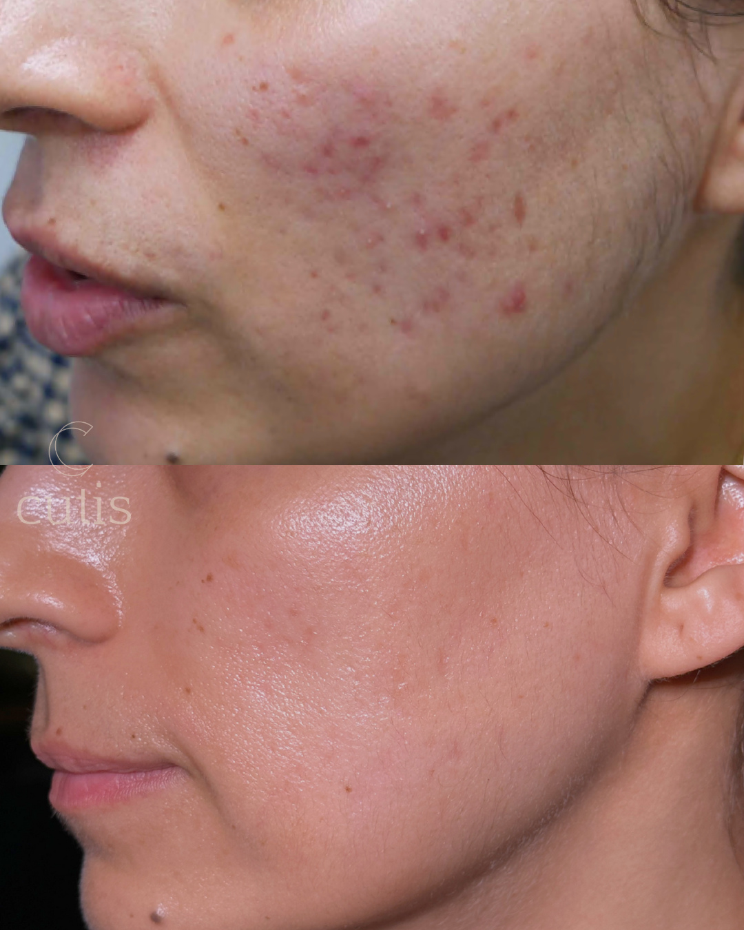 Rejuran S for Acne Scars: Everything You Need to Know