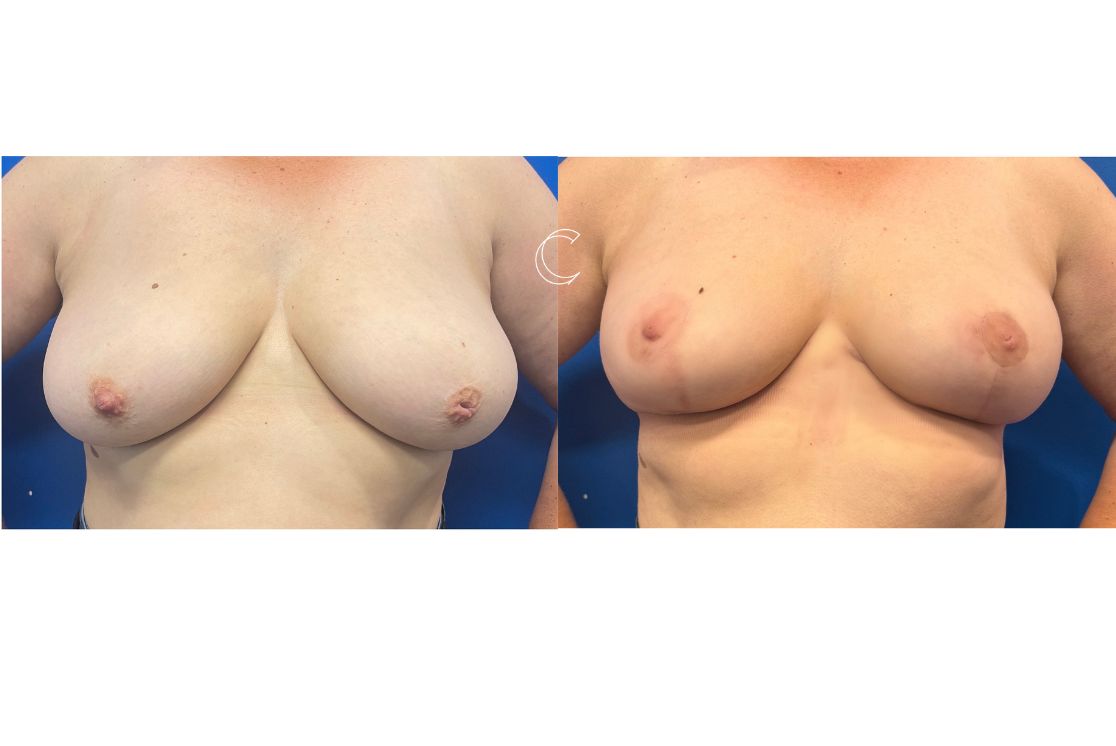 breast reduction surgery brisbane 2