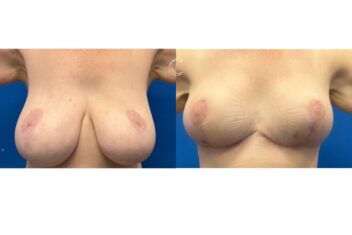 breast reduction surgery brisbane 3