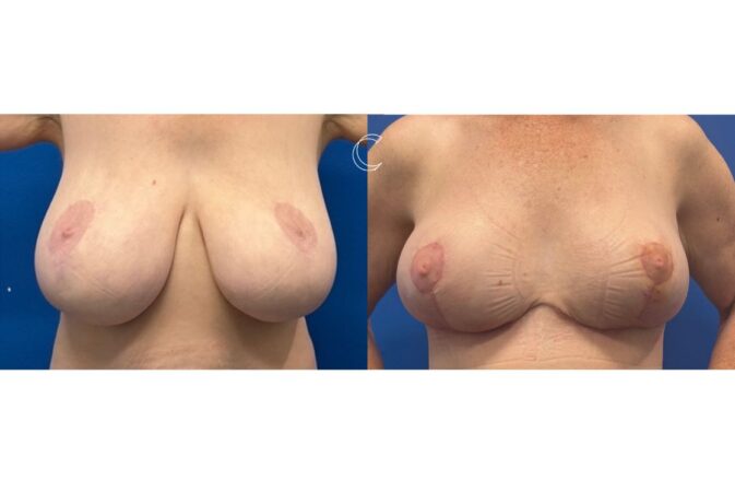 breast reduction surgery brisbane 4