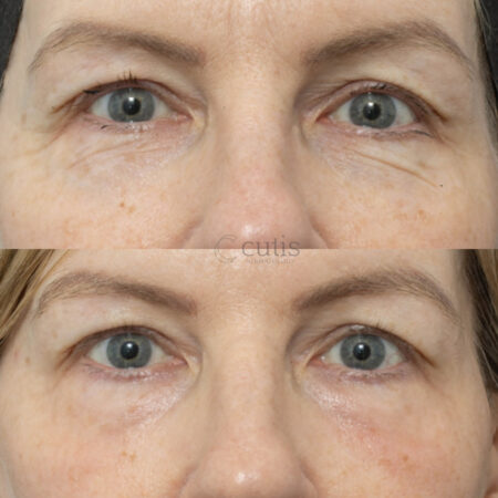co2 eye rejuvenation brisbane 93846