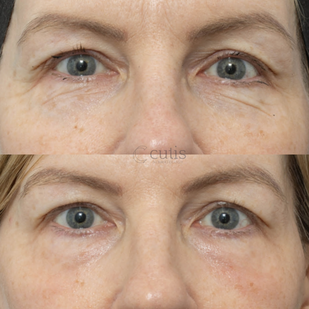 co2 eye rejuvenation brisbane 93846