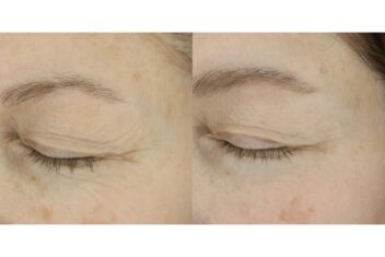 mosaic co2 before after 2