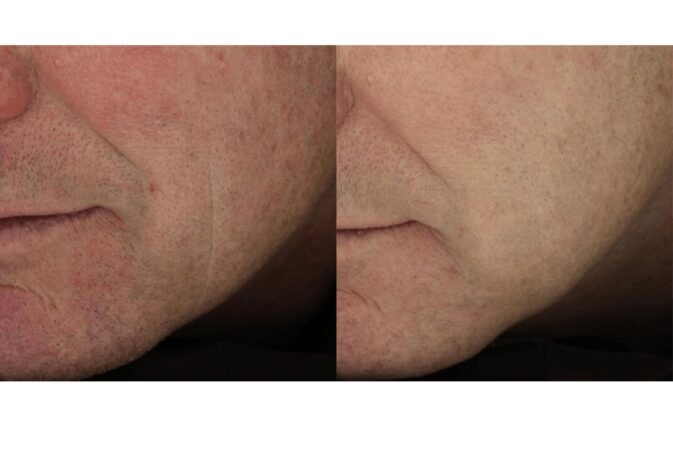 mosaic co2 before after 3