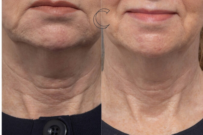 ultraformer neck brisbane