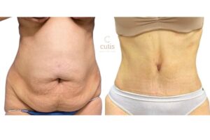 abdominoplasty surgeon brisbane