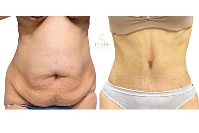 abdominoplasty surgeon brisbane