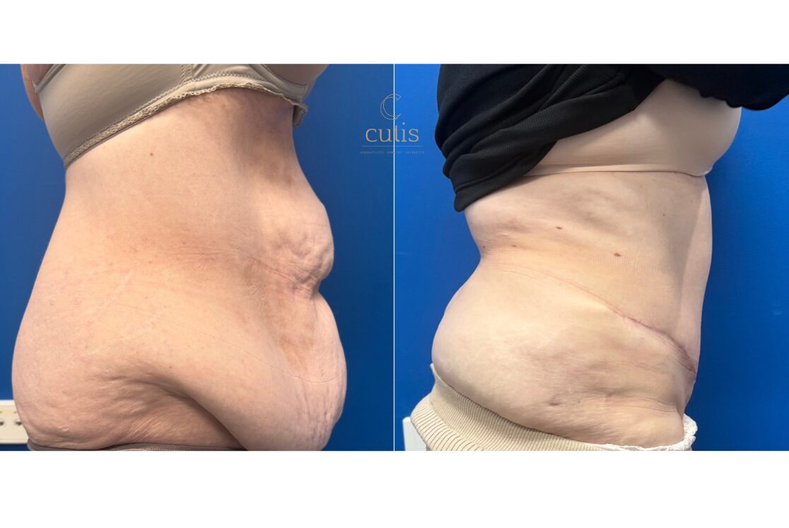 abdominoplasty surgery brisbane
