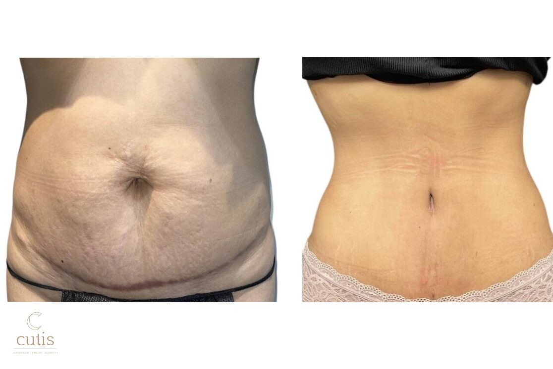 abdominoplasty brisbane