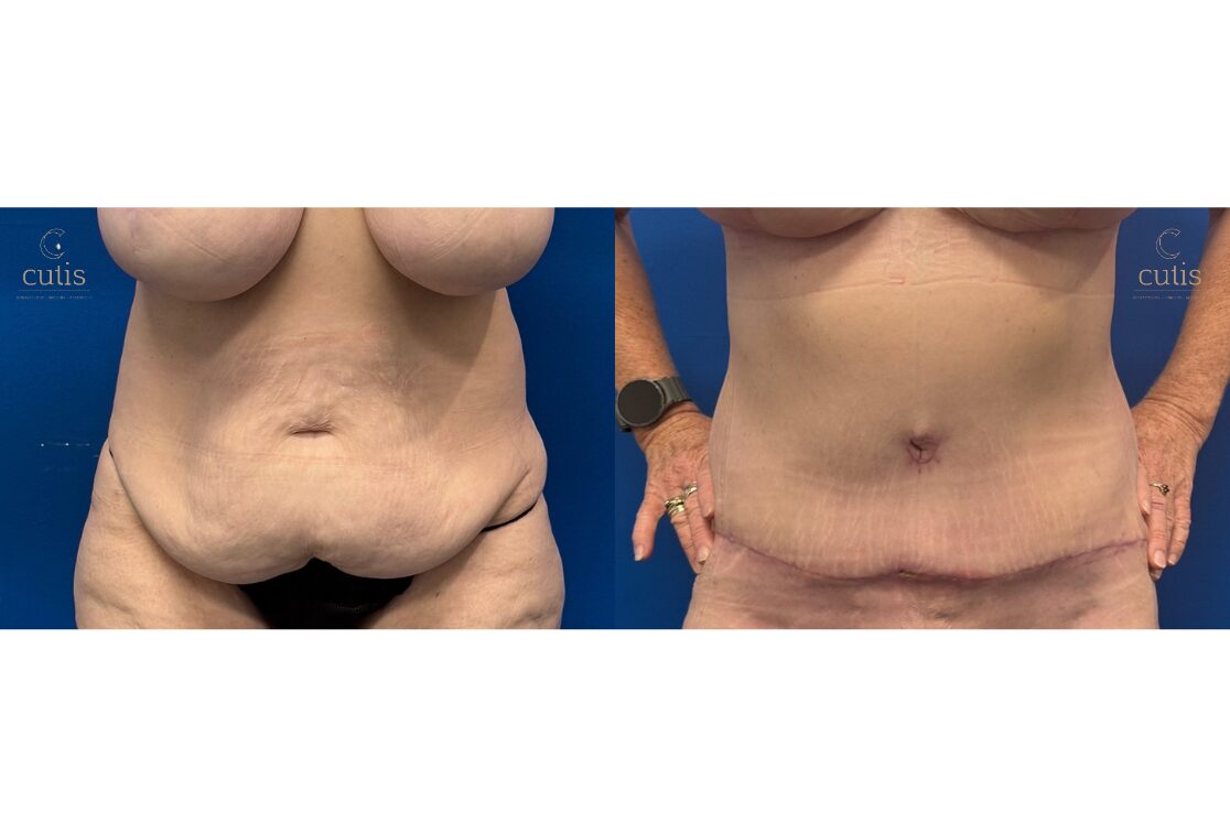 abdominoplasty tummy tuck surgery 2