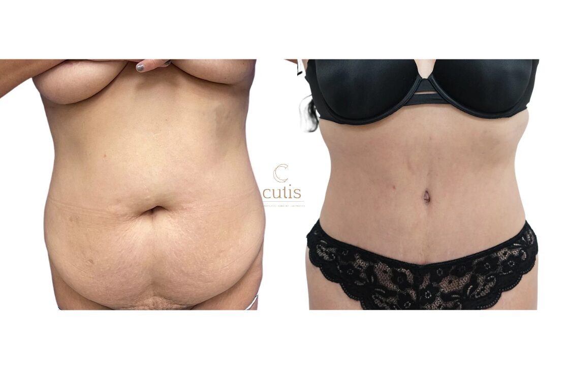 abdominoplasty tummy tuck surgery