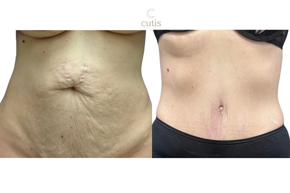 abdominoplasty brisbane