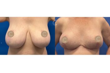 breast reduction surgery brisbane