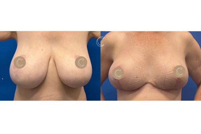 breast reduction surgery brisbane
