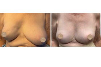 breast symmetrisation reduction before and after
