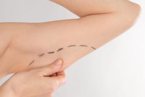 brachioplasty