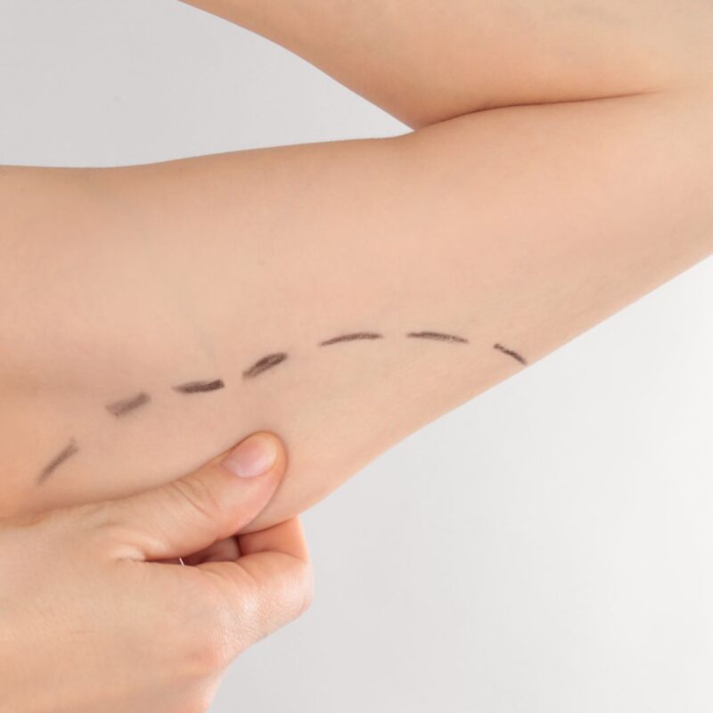 brachioplasty