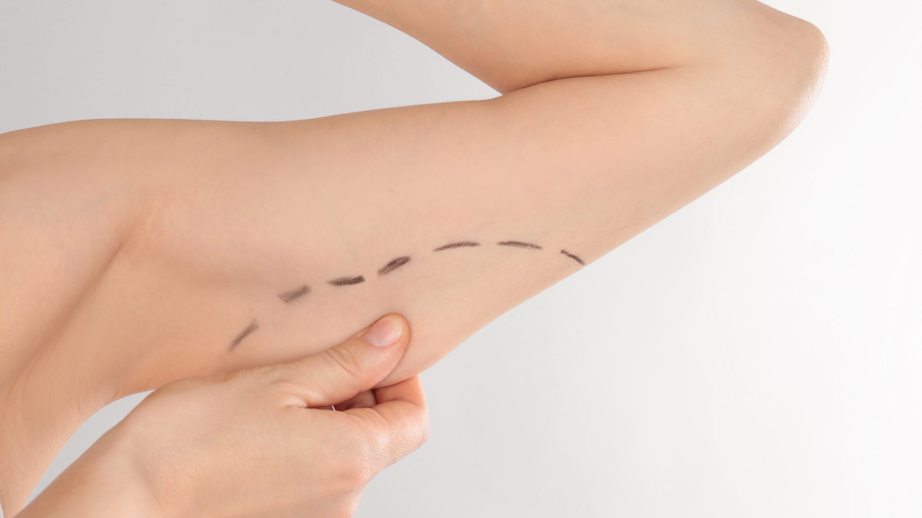 5 Benefits of Choosing a Board-Certified Plastic Surgeon for Brachioplasty Surgery