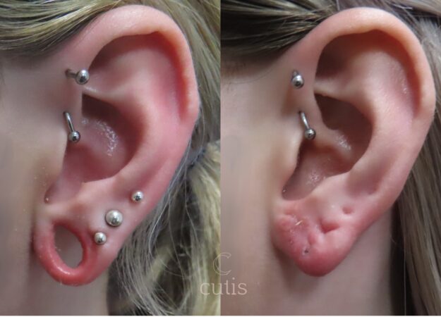 earlobe repair brisbane