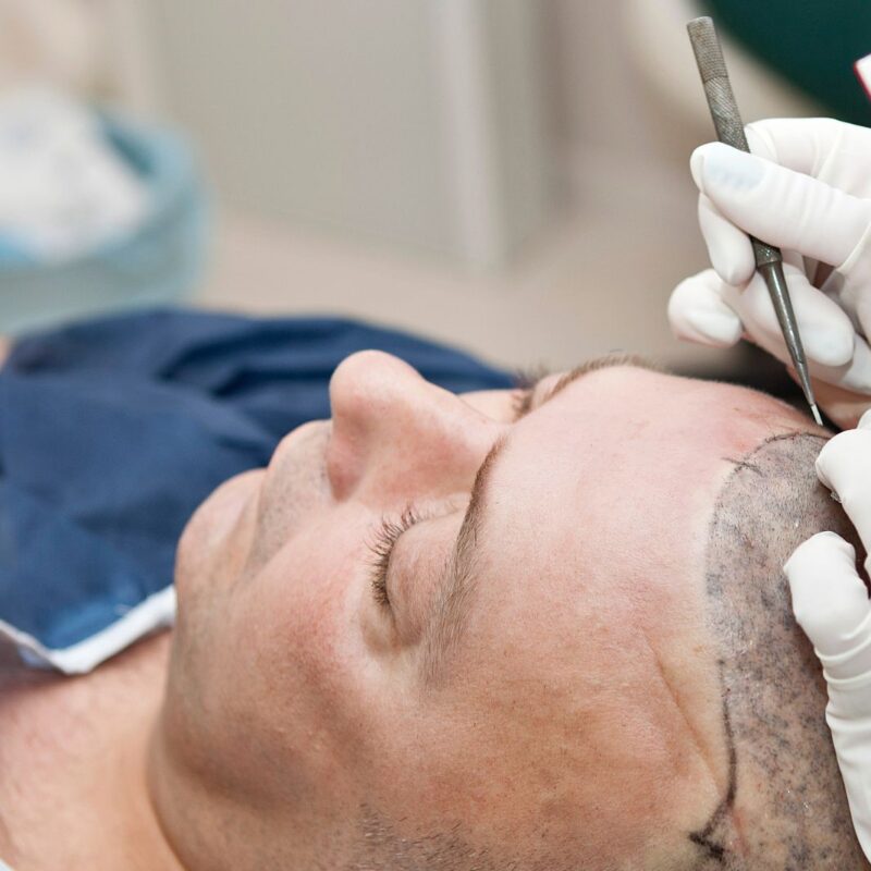 fua hair transplant brisbane