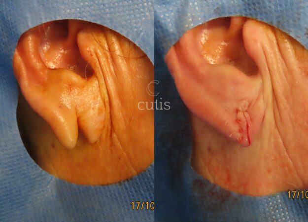 split earlobe repair brisbane