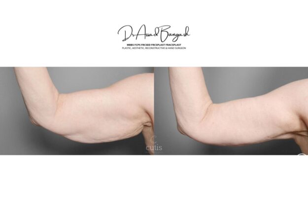 brachioplasty brisbane