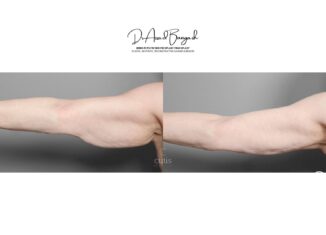 brachioplasty arm lift 1