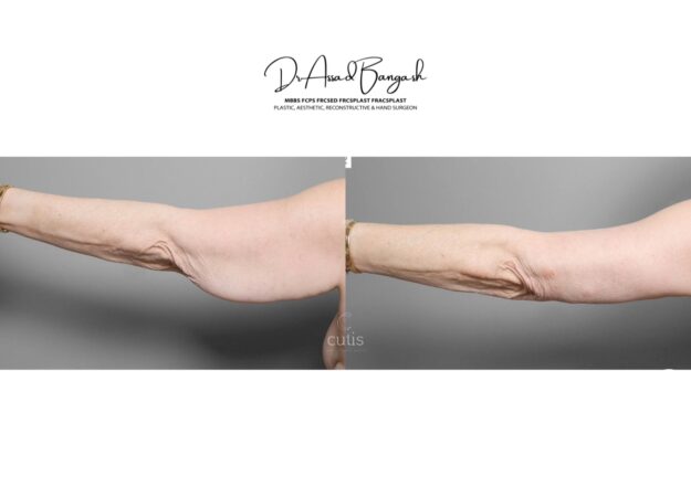 brachioplasty brisbane