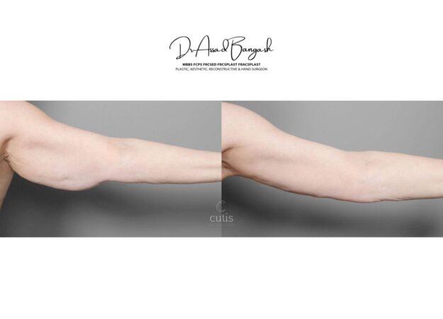 brachioplasty brisbane