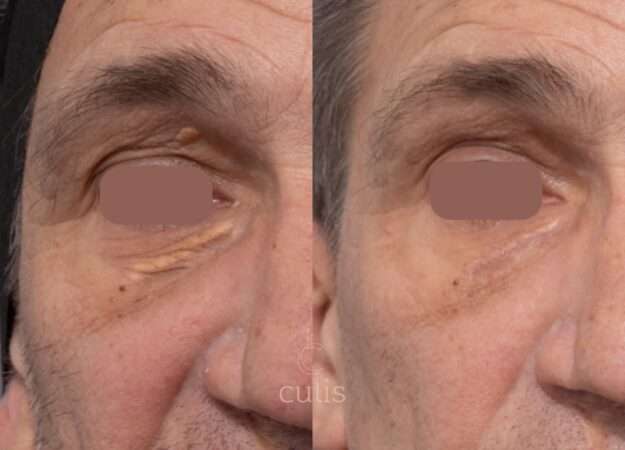 xanthelasma treatment brisbane