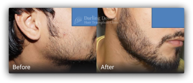 beard transplant brisbane 11