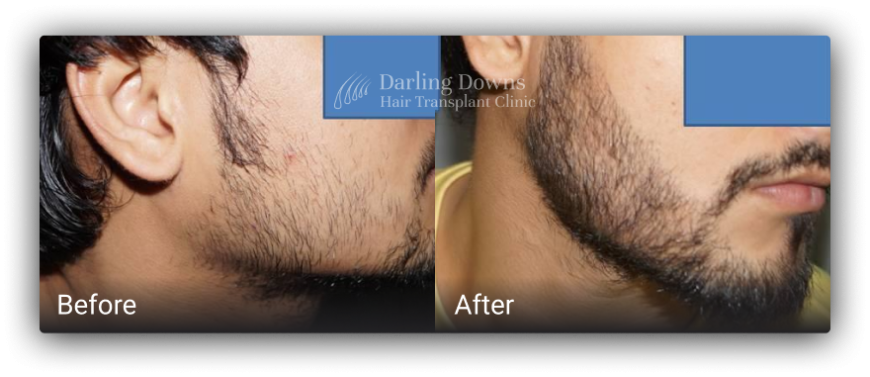 beard transplant brisbane 11