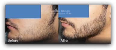 beard transplant brisbane