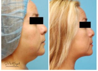 liposuction in brisbane
